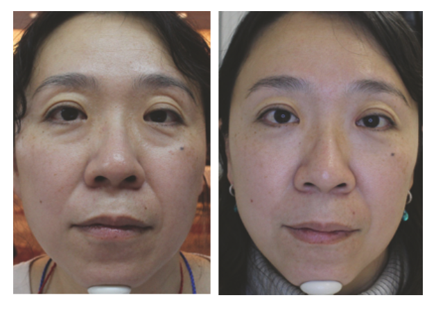 fotona 4d facelift before and after